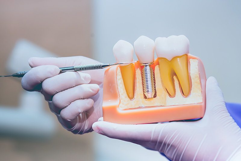 maqueta de implantes dentales