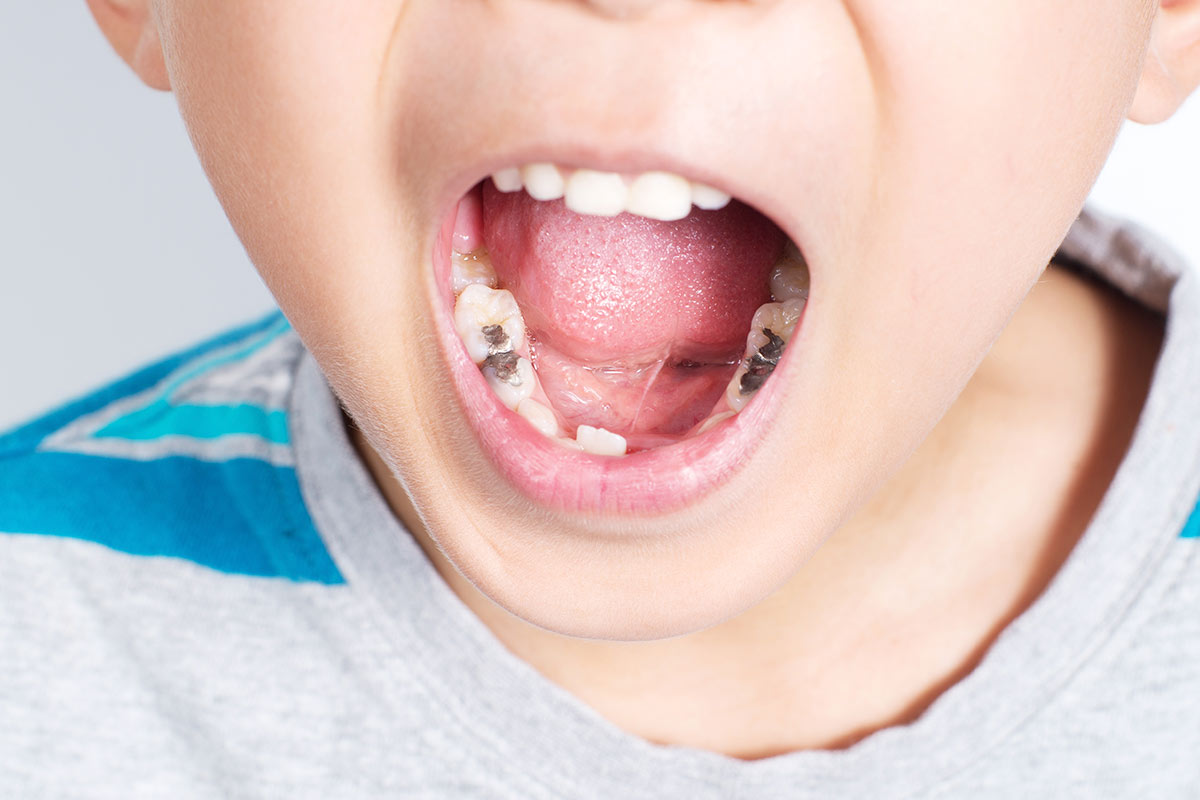 Caries dental en niño