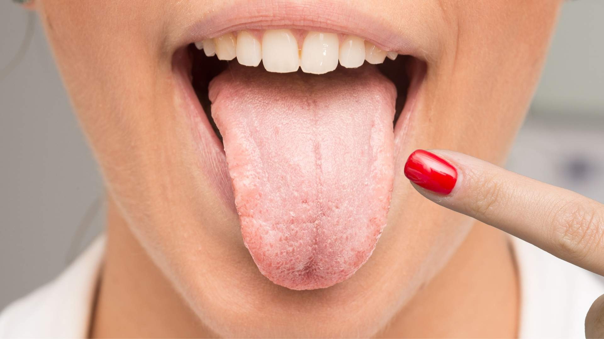 Paciente sacando la lengua