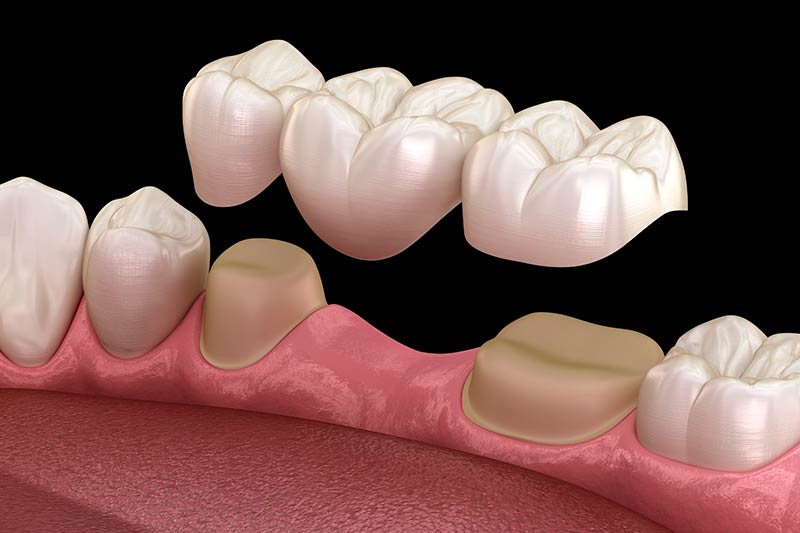 protesis-dental-dientes-tallados