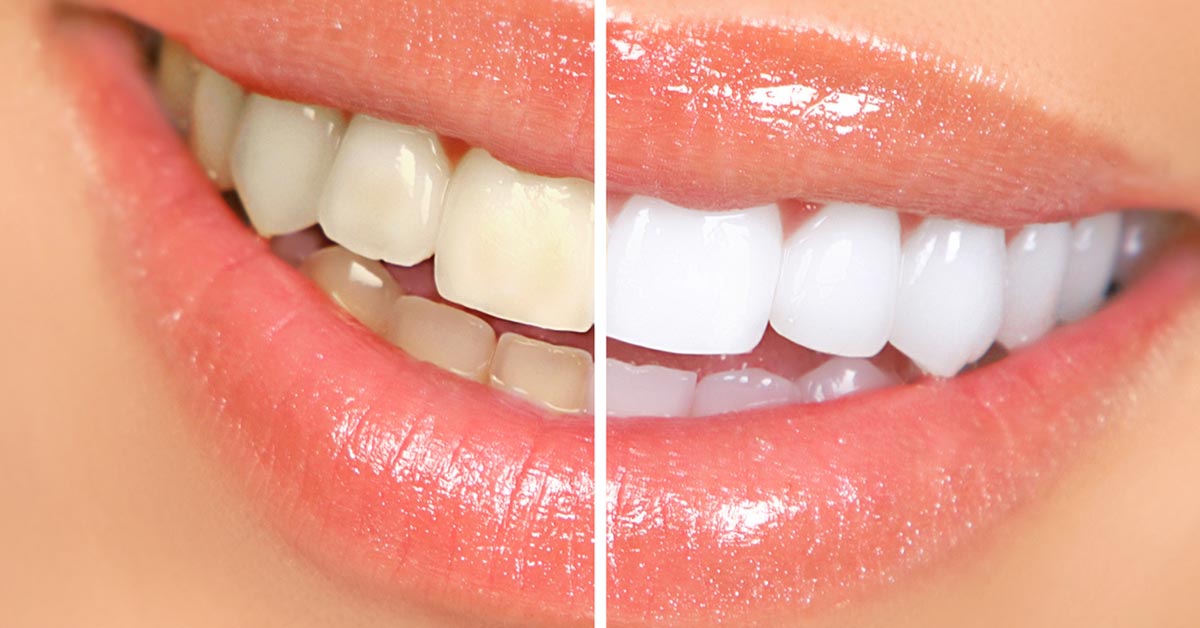 Blanqueamiento dental antes después de dientes amarillos