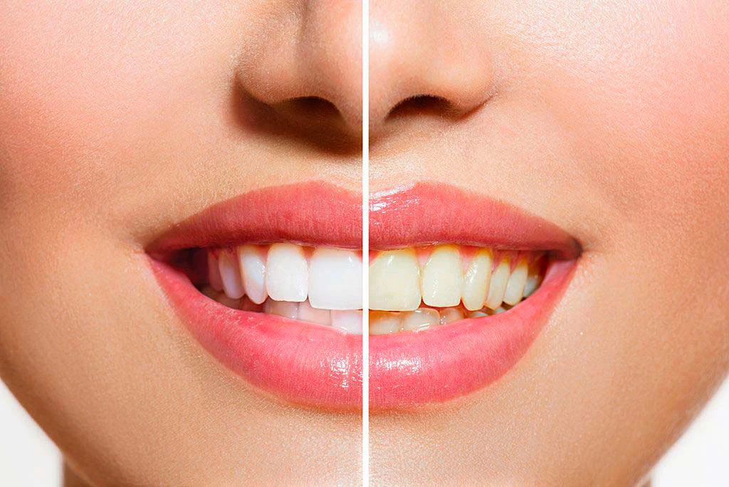 blanqueamiento dental resultados