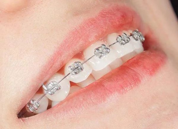 Brackets metálicos Las Palmas