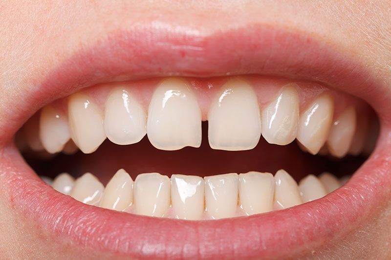 tratamiento-corregir-separacion-dientes