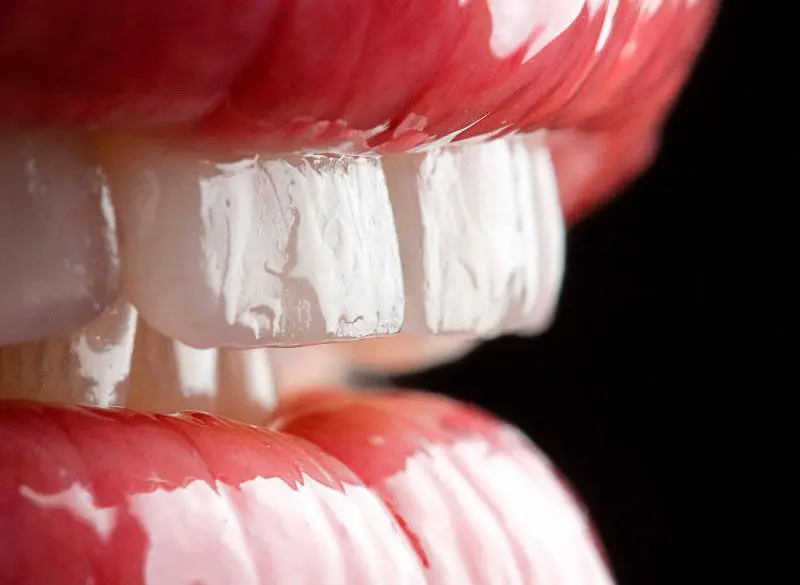 Tratamiento carillas dentales