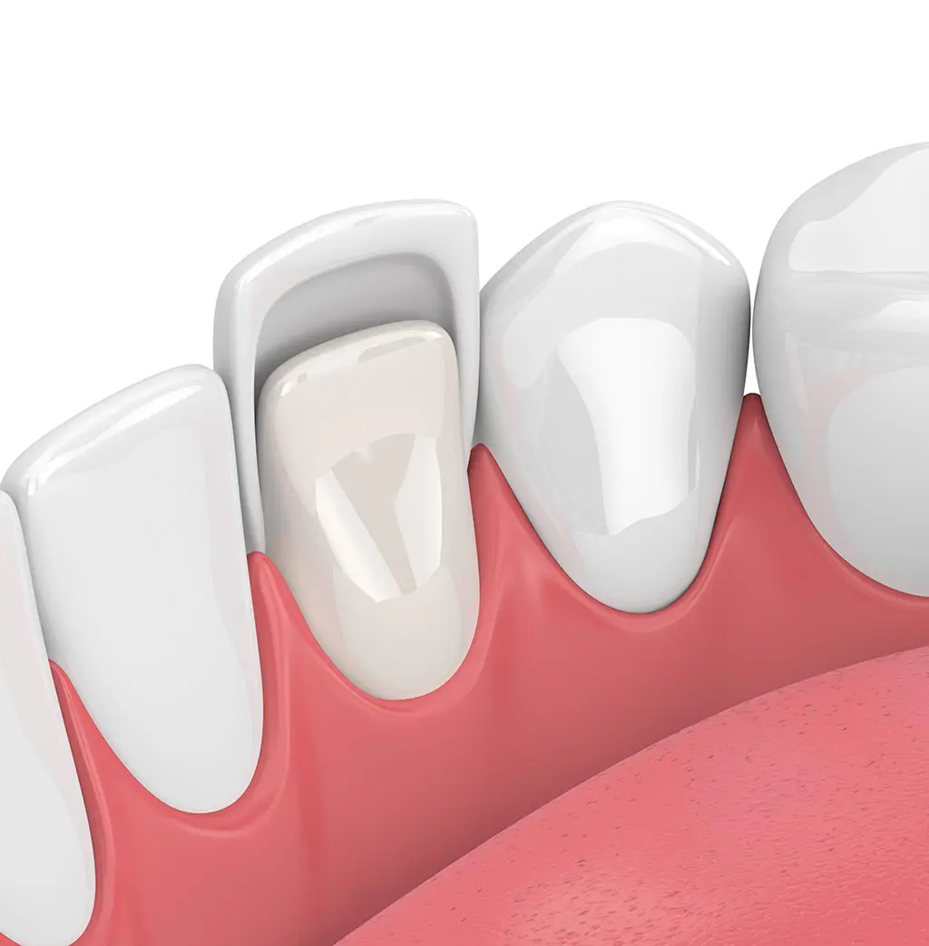 problemas carillas dentales