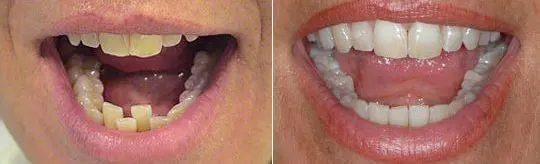 Antes y después