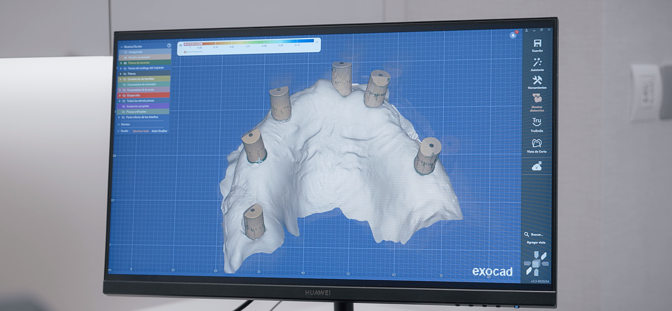 estudio colocación de implantes dentales